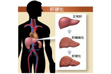 C型肝炎雖然已治癒 原來的肝硬化並不會消失