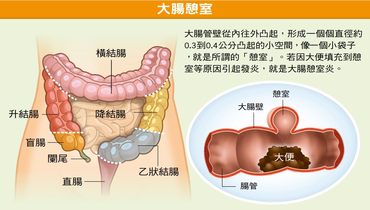 後 盲腸 術