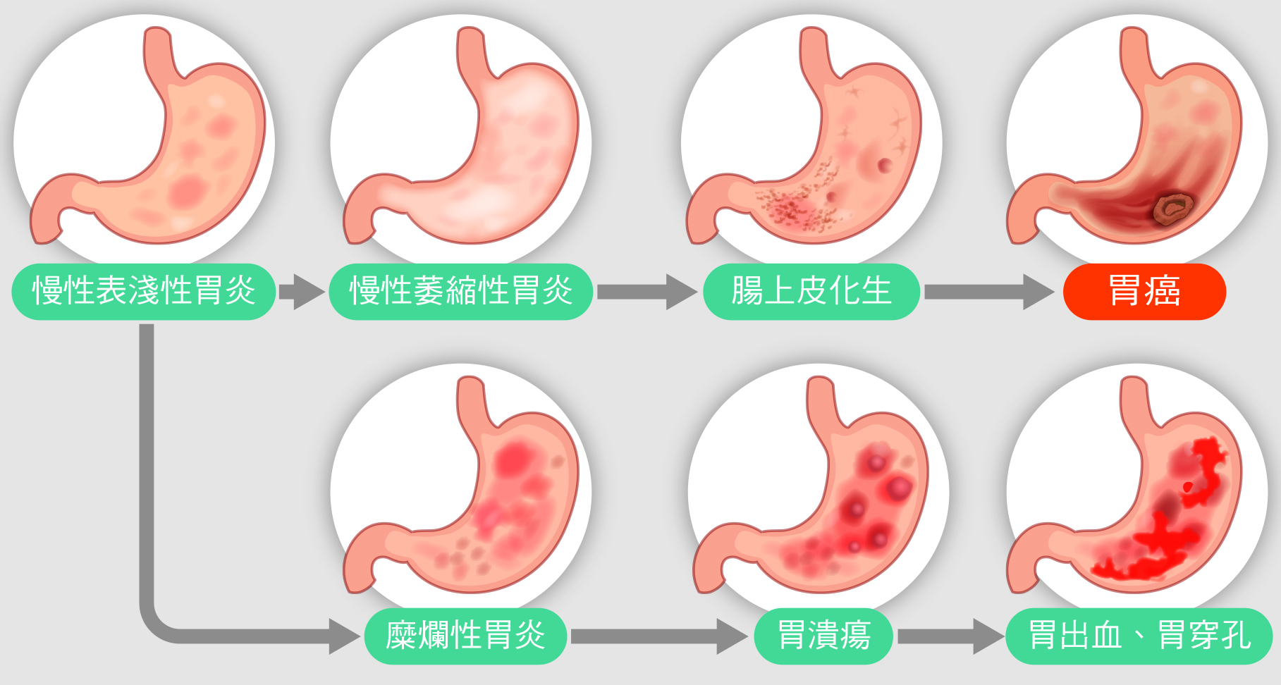 胃悶痛、消化不良…當心萎縮性胃炎！