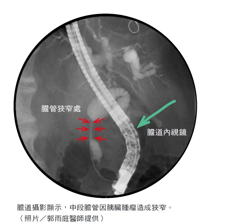 腸 間 膜 脂肪 織 炎